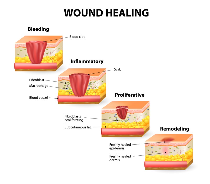 Wound Healing