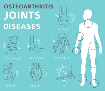 Magcell Arthro Provides Pain Relief in Foot Osteoarthritis